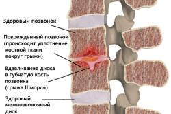 Mi SHmorlja csomópontok (összes hernia) Mi SHmorlja csomópontok