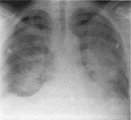 Diagnózis, differenciál diagnózis és a kezelés a tüdő parenchyma kompressziós szindróma