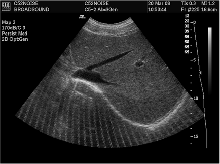Doppler ultrahang terhesség mi ez, hogyan