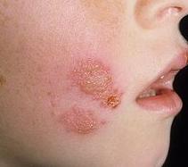 Herpes az arcon fotó kezelést otthon, gyorsan és hatékonyan
