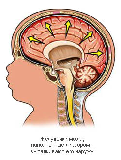 Hydrocephalus gyermekeknél