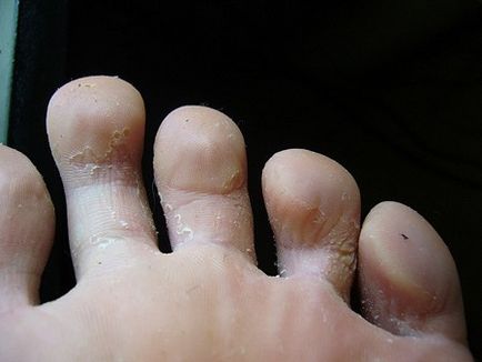 Gombák a lábán, fotó (kép) Gomba lábán Photo