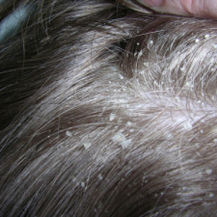 Hogyan és milyen kezelésére seborrhea, szeborreás dermatitisz a fejét - Kép, okai, tünetei
