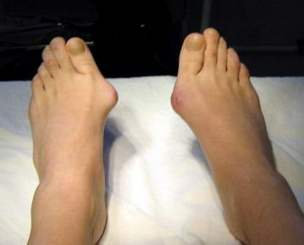 Hogyan lehet megszabadulni a kövek a lábát, módszerek vetőmag kezelésére a lábakon, a hatáskörébe tartozó egészségügyi