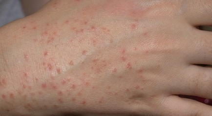 Hogyan allergia háztartási vegyszerek emberekben, stop allergia