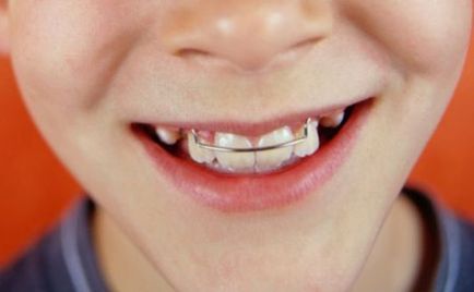 Hogyan, hogy összehangolják a fogak nélkül fogszabályozó, hogy lehet használni otthon