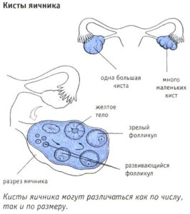 Petefészek ciszta tünetek a nők, jelei törés