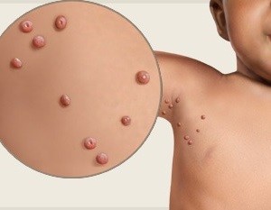 Molluscum contagiosum kép, tünetek, kezelés otthon, lézeres abláció (belföldi) Molluscum contagiosum képeket, tünetek, kezelés otthon, lézeres eltávolítása