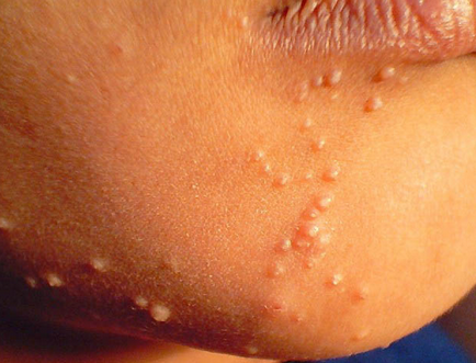 Molluscum contagiosum képeket, tünetek, kezelés otthon, lézeres eltávolítása