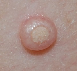 Molluscum contagiosum képeket, tünetek, kezelés otthon, lézeres eltávolítása