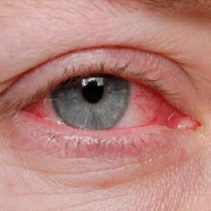 Kezelés és allergia tünetei fahéj - szól allergia