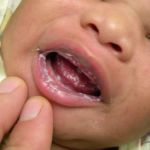 Szájnyálkahártya fekély csecsemők - okai, tünetei, kezelése, megelőzése