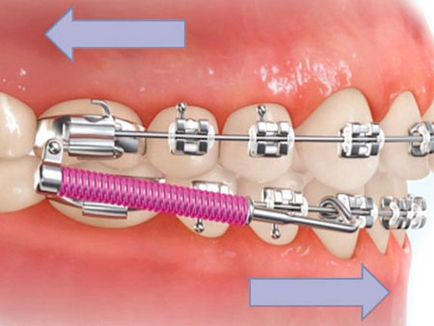 Malocclusion típusú rendellenességek, fotók, kezelések