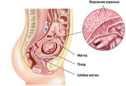 Chorionic leválás a korai chorion a terhesség korai szakaszában okoz és a megelőzés