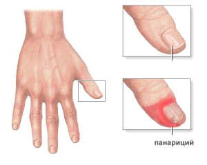 Bűnöző kéz- és lábujjak - milyen gyorsan gyógyul a gyulladást és a szövődmények megelőzése