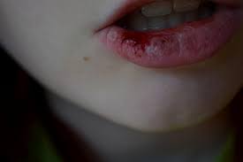 Miért harap az ajkak okoz a rossz szokások cikk