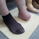 A protézis láb