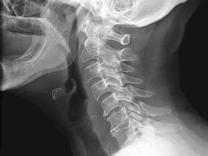 Spondylosis nyaki gerinc tünetei, kezelése