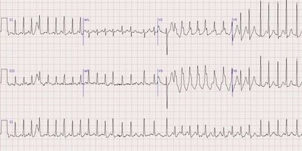 Tachycardia - tünetek és kezelés tabletták és népi jogorvoslati