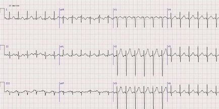 Tachycardia - tünetek és kezelés tabletták és népi jogorvoslati