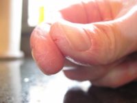 Repedések a kéz és az ujjak (a golyó, a tippeket, a redők között) okozza és a kezelés fotók