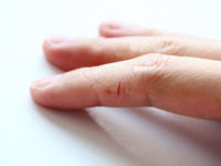 Repedések a kéz és az ujjak (a golyó, a tippeket, a redők között) okozza és a kezelés fotók