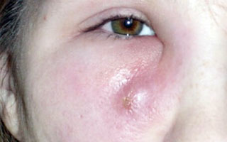 A gyermek a szem alatti duzzanat - Okok és kezelés