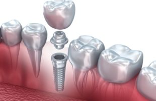 Egyes esetekben van egy elutasítás a fogászati ​​implantátum
