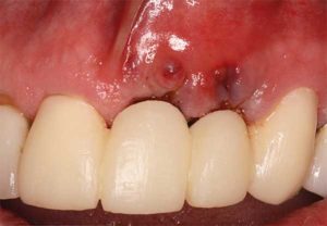 Egyes esetekben van egy elutasítás a fogászati ​​implantátum