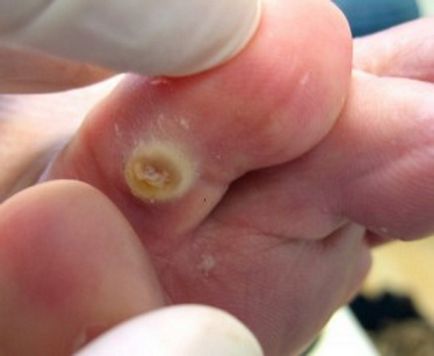 Benőtt bőrkeményedés az ujjak okoz a lábak, a kezelés a professzionális és otthoni