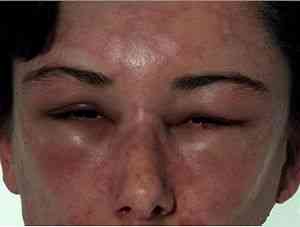 Allergiás az arc kezelés - a megfelelő arckezelés - cikkek Directory - hogyan lehet szép