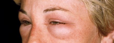 Allergia szembe krémet okok, tünetek, kezelés