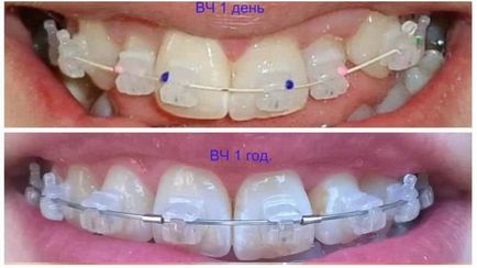 Nadrágtartók - fotók előtt és után összehangolását malocclusion