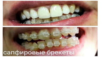 Nadrágtartók - fotók előtt és után összehangolását malocclusion