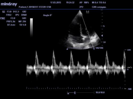 Mit jelent a szív ultrahang átirat elkészítése