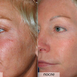 Mi mandula peeling javallatok és ellenjavallatok, az árak (előtti és utáni képek) (mandulasav) Mi mandula peeling javallatok és ellenjavallatok, az árak (előtti és utáni képek)