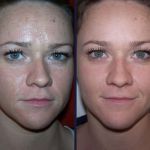 Mi mandula peeling javallatok és ellenjavallatok, az árak (előtti és utáni képek) (mandula) Mi mandula peeling javallatok és ellenjavallatok, az árak (előtti és utáni képek)