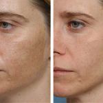 Mi mandula peeling javallatok és ellenjavallatok, az árak (előtti és utáni képek) (mandulasav) Mi mandula peeling javallatok és ellenjavallatok, az árak (előtti és utáni képek)