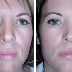 Mi mandula peeling javallatok és ellenjavallatok, az árak (előtti és utáni képek) (peeling) Mi mandula peeling javallatok és ellenjavallatok, az árak (előtti és utáni képek)