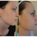 Mi mandula peeling javallatok és ellenjavallatok, az árak (előtti és utáni képek) (mandulasav) Mi mandula peeling javallatok és ellenjavallatok, az árak (előtti és utáni képek)