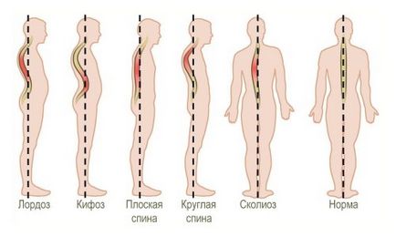 élettani lordosis