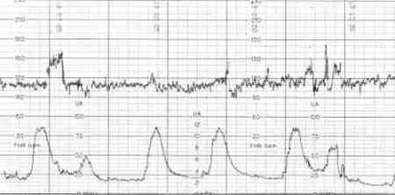 CTG terhesség alatt dekódolás, sebesség, káros vagy nem; hogy milyen időszakban és hogyan CTG alatt