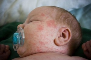 malária kezelésére csecsemők, valamint, mint kezelni malária az újszülött