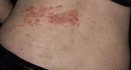 Herpes zoster tünetei és kezelése Felnőttek