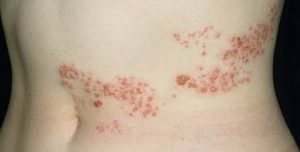 Herpes zoster tünetei és kezelése Felnőttek