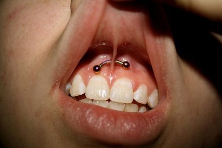 Piercing smiley - fotók, fájdalom, következmények, kockázatok, ár