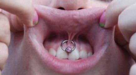 Piercing smiley - fotók, fájdalom, következmények, kockázatok, ár