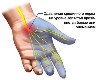 Miért zsibbad keze alvás közben okai és kezelése zsibbadása kéz és az ujjak éjjel