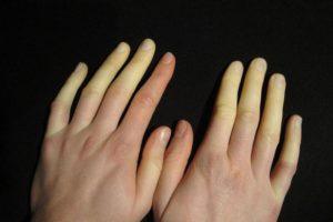 Miért zsibbadt ujjai okoz és kezelés