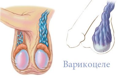 Következményei varicocele a férfiak, ha nem kezelik és a kezelt